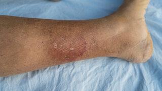 Basit bir enfeksiyon değil: İçten içe çürütüyor! Sepsis nedir?