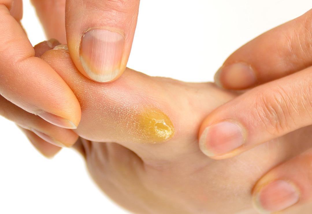 İki malzemeli mucize &ccedil;&ouml;z&uuml;m: Ne nasır kalır ne de ağrı!