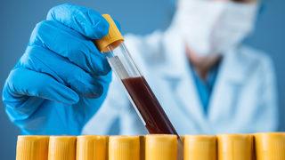 Kan tahlili sonucu öğrenme: e-Nabız ile kan tahlili sonucu nasıl öğrenilir, kan tahlili sonuçları ne zaman çıkarı?