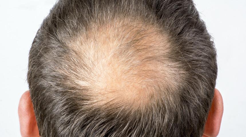 Yüzde yüz çalışıyor! Kellik tarihe karışıyor: Tedavisi bulundu