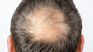 Yüzde yüz çalışıyor! Kellik tarihe karışıyor: Tedavisi bulundu