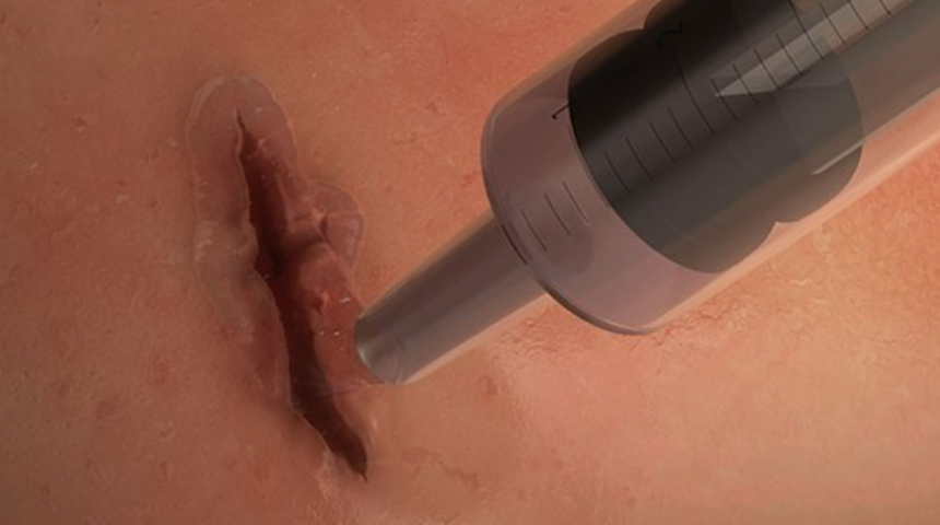 Avusturyalı bilim adamlarından mucizevi buluş! Yaraları dikişe gerek kalmadan kapatıyor