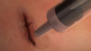 Avusturyalı bilim adamlarından mucizevi buluş! Yaraları dikişe gerek kalmadan kapatıyor