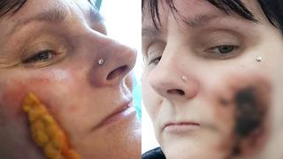 Temizlik yaparken dikkatsizliğinin kurbanı oldu: Yanağında kocaman delik açıldı!