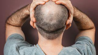 Kel olan erkekler dikkat! Kalp hastalığı riskiniz daha yüksek