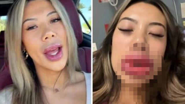 Dudak dolgusu yaptırdı, kabus yaşadı! Son halini görünce gözlerine inanamadı