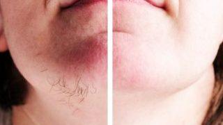 Yüz tüylerinizden kurtulmanızı sağlayacak en etkili bitkisel kürler