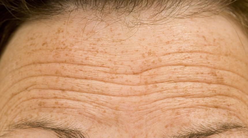 Derin alın kırışıklıkları tedavi edilebilir mi?