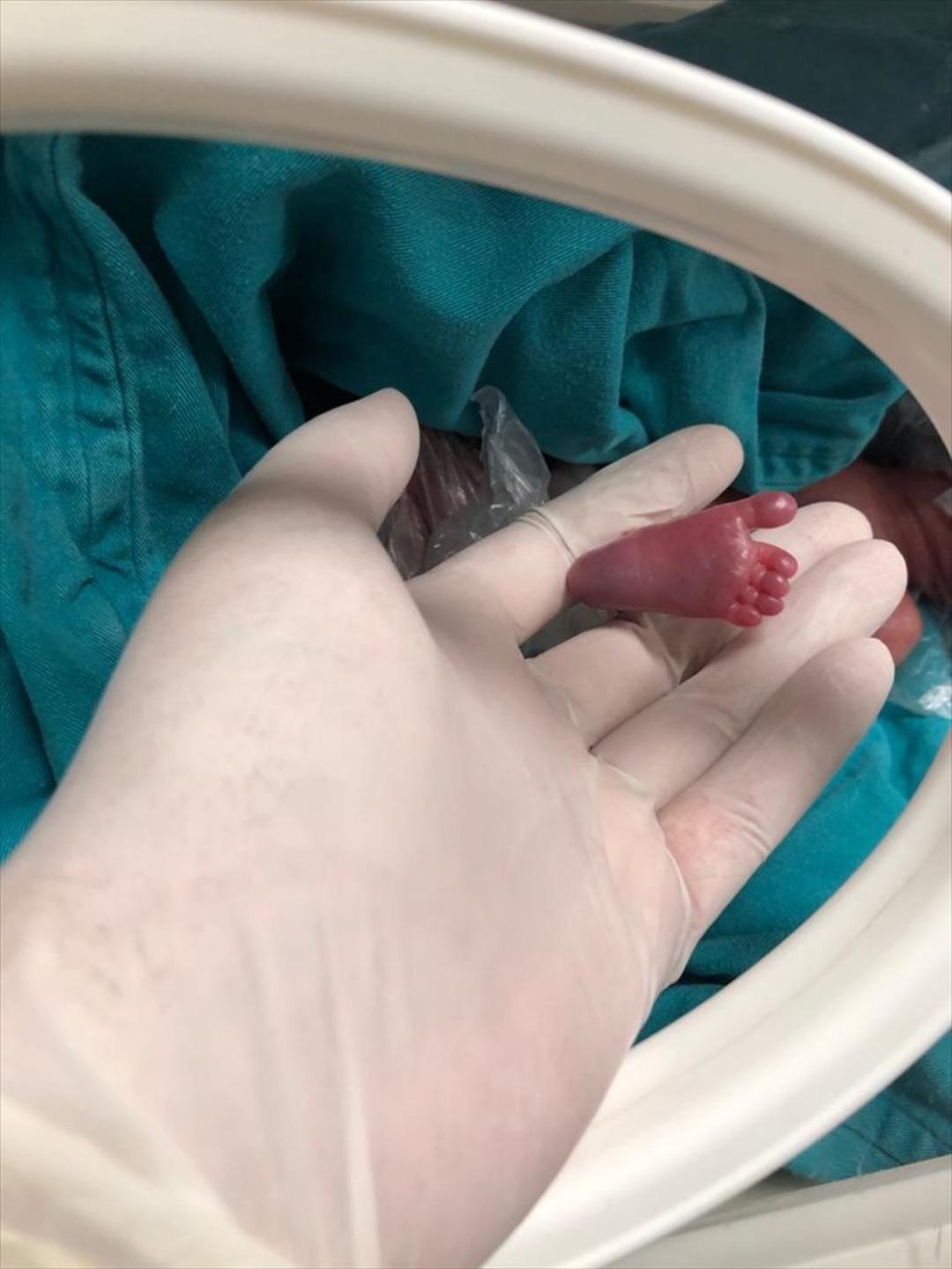 540 gram doğan mucize bebek Burak! Aylarca yoğun bakımda kaldı... 'Organı gelişmeden doğup yaşayan &ccedil;ok az bebek var'