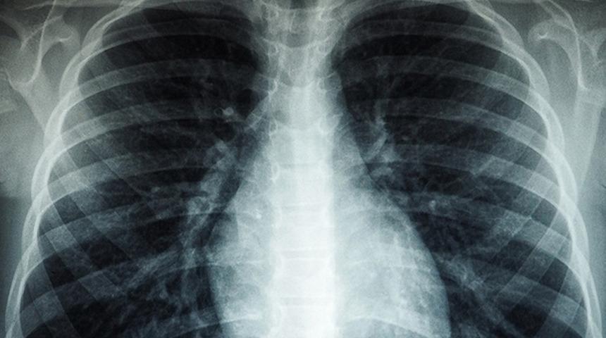 Dünya Sağlık Örgütü'nden tedirgin eden açıklama! Tüberküloz vakaları yıllar sonra artışa geçti