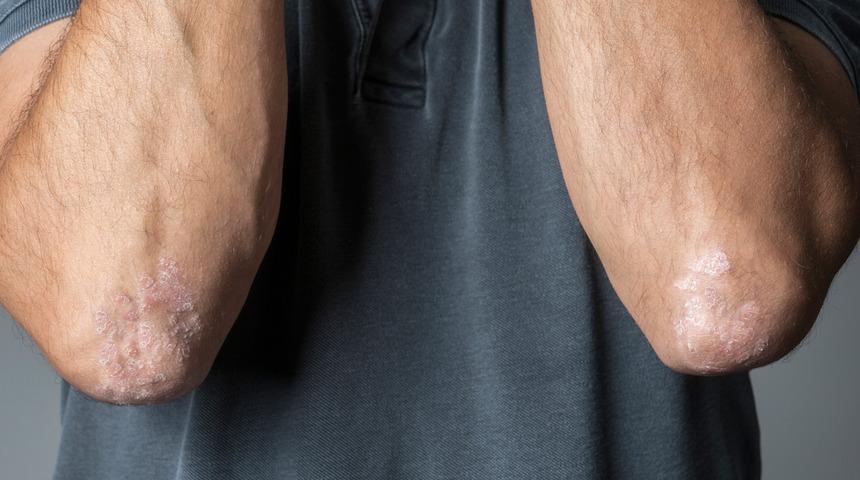 Egzama düşündüğünüz kadar kötü olmayabilir! Ölümcül hastalığa karşı koruyabilir