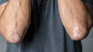 Egzama düşündüğünüz kadar kötü olmayabilir! Ölümcül hastalığa karşı koruyabilir