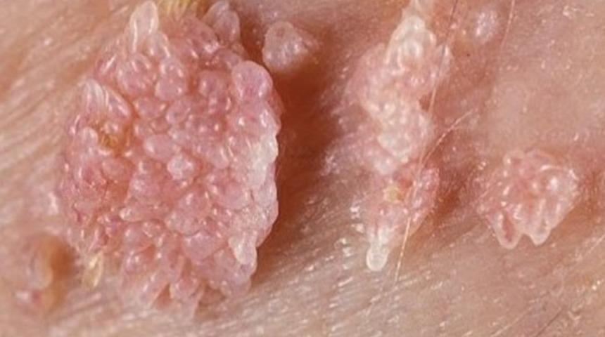 Genital siğil (HPV) tanısı ve tedavisi nedir?