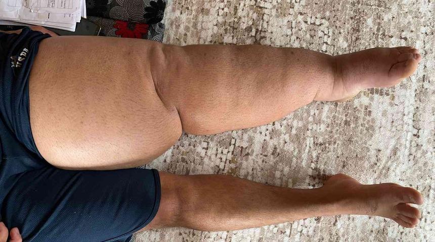 5 yıl &ouml;nce tekstil fabrikasında kaza ge&ccedil;iren gencin ayağının şişmesiyle hayatı kabusa d&ouml;nd&uuml;