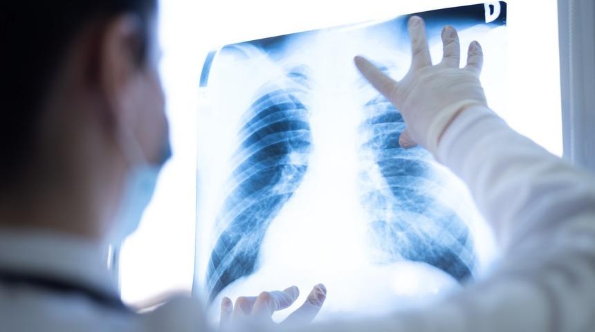 Akciğer kanseri bazen tesadüfen tespit edilebiliyor
