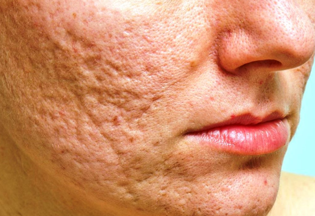 Y&uuml;z &ccedil;ukurları i&ccedil;in etkili maske tarifi! Y&uuml;z &ccedil;ukurları nasıl ge&ccedil;er?