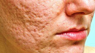 Yüz çukurları için etkili maske tarifi! Yüz çukurları nasıl geçer?