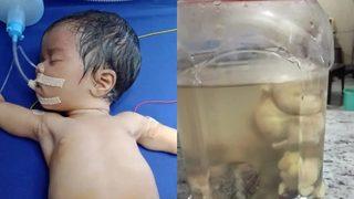 Yenidoğan bebeğin midesinden çıkanlar dudak uçuklattı: Tam 8 tane!