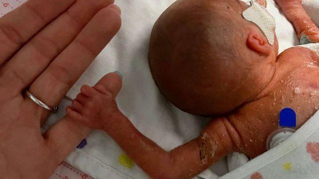 ''Bir ekmekten hafifti'' Yaşama şansı %10 dediler! Hayatta kalmayı başardı ama...