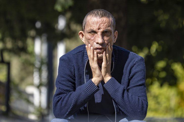 Türkiye onları yapılan yüz nakilleriyle tanımıştı! 10 yılda hayatları değişti, işte Uğur Acar ve Turan Çolak'ın son halleri... G1