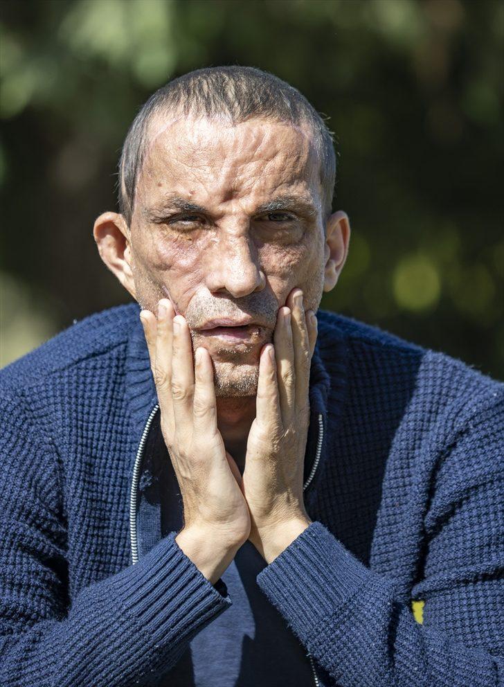 Türkiye onları yapılan yüz nakilleriyle tanımıştı! 10 yılda hayatları değişti, işte Uğur Acar ve Turan Çolak'ın son halleri... G2