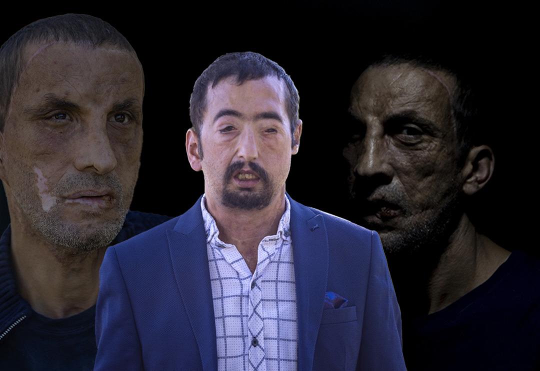 T&uuml;rkiye onları yapılan y&uuml;z nakilleriyle tanımıştı! 10 yılda hayatları değişti, işte Uğur Acar ve Turan &Ccedil;olak'ın son halleri...