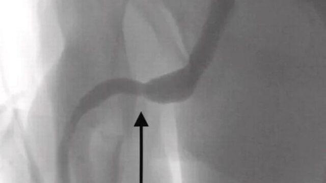 Cinsel deney isteği doktorları bile şaşkına çevirdi! Penisinden metrelerce uzunlukta USB kablosu çıktı