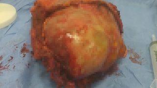 Göğüs ağrısı şikayetiyle hastaneye gitti, vücudundan 6 kiloluk kitle çıkarıldı!