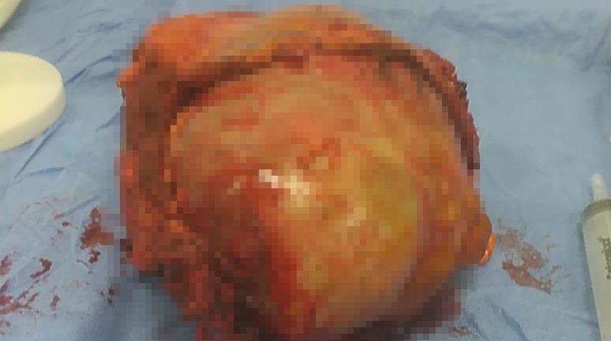 Göğüs ağrısı şikayetiyle hastaneye gitti, vücudundan 6 kiloluk kitle çıkarıldı!