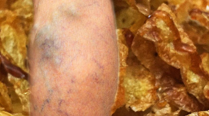 İlk sinyal bacaklardan geliyor! Sonrası kalp krizi, felç...