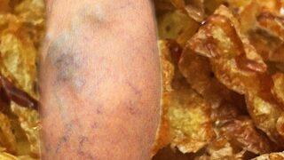 İlk sinyal bacaklardan geliyor! Sonrası kalp krizi, felç...