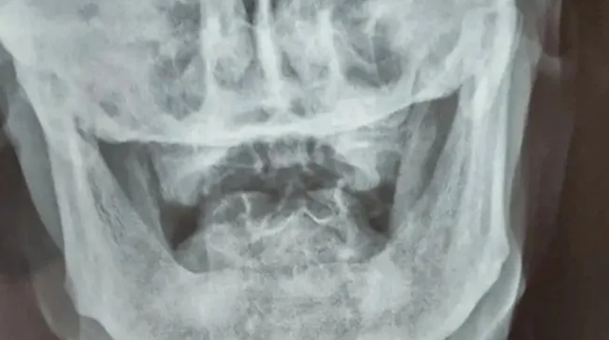 İkinci Dünya Savaşı’ndan kalan kurşunla tam 80 yıl yaşadı! “Haberim bile yoktu, görünce şoke oldum”