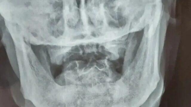 İkinci Dünya Savaşı’ndan kalan kurşunla tam 80 yıl yaşadı! “Haberim bile yoktu, görünce şoke oldum”