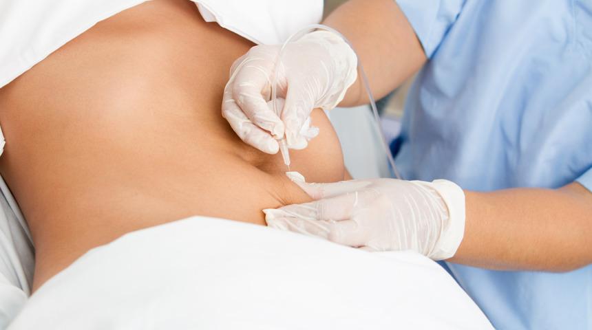 Liposuction hakkında t&uuml;m merak ettikleriniz...