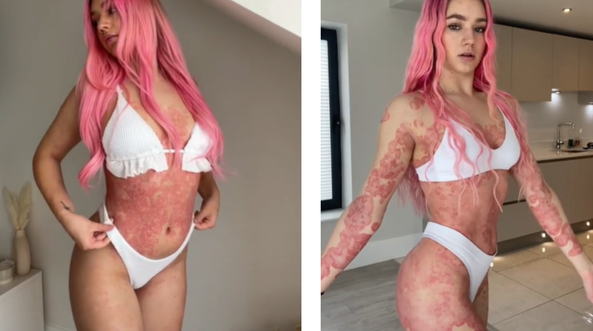 Hastalığı nedeniyle vücudunun yüzde 90'ı lekeyle kaplı! Genç kadın hastalığa yol açan nedenin yaygın kullanılan ilaç olduğunu düşünüyor