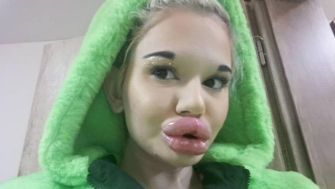 D&uuml;nyanın en b&uuml;y&uuml;k dudaklarına sahip! &ldquo;Doktorlar &ouml;lebileceğimi s&ouml;yl&uuml;yor ama durmayacağım&rdquo;