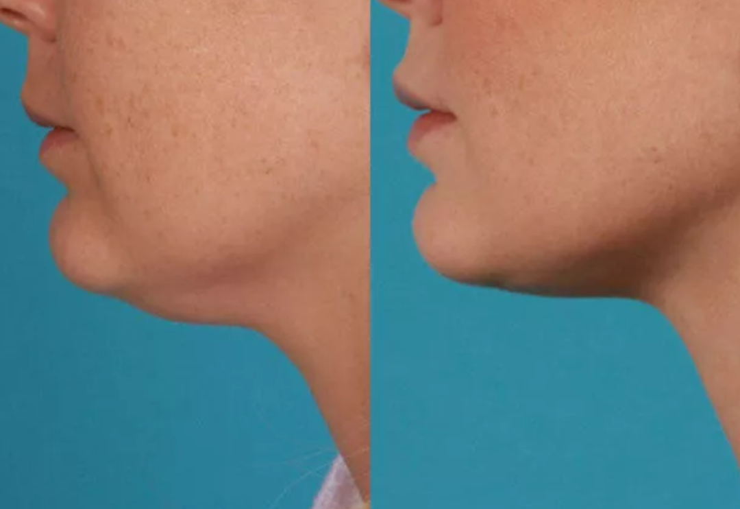 Gıdınıza 7 g&uuml;nde veda edin! Evde gıdı eritme hareketleri