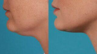 Gıdınıza 7 günde veda edin! Evde gıdı eritme hareketleri