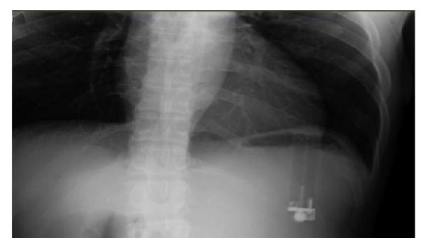 Yuttuğu çakmak yüzünden ülser oldu