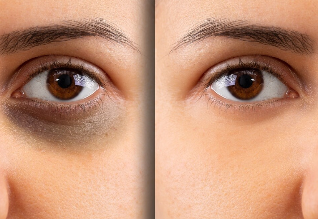 G&ouml;z altı morluklarına kesin &ccedil;&ouml;z&uuml;m! G&ouml;z altı morluklarına ne iyi gelir?