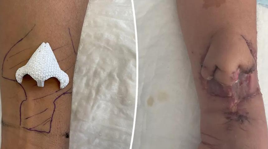 Kolunda b&uuml;y&uuml;tt&uuml;ğ&uuml; burnu y&uuml;z&uuml;ne naklettiler