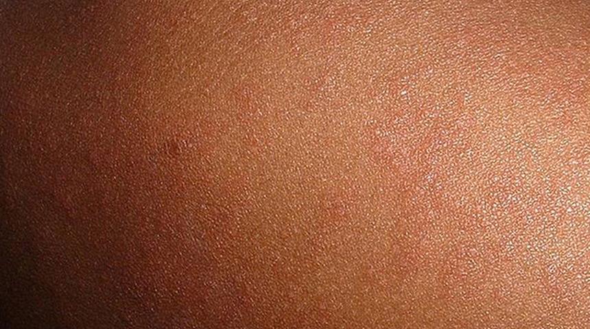 O ülkede kızamık salgını alarmı! Vaka sayısı 35'e yükseldi