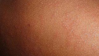 O ülkede kızamık salgını alarmı! Vaka sayısı 35'e yükseldi