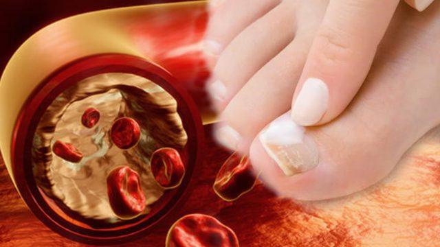 Görmezden gelmeyin: Tehlikeli hastalığın ilk belirtilerinden! Uzuv kaybına neden olabilir