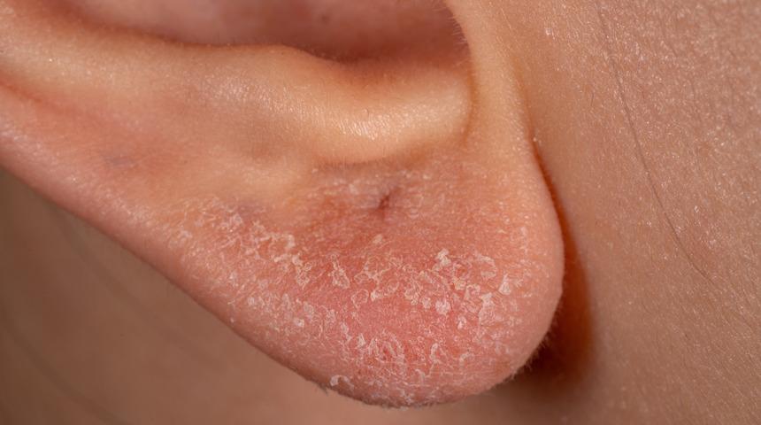 Deri hastalıklarını tetikliyor