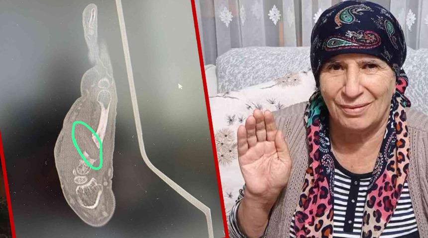 Bir garip olay! Yanlış tanı nedeniyle hayatı kabusa döndü... Elinin içinde odun parçası unutuldu