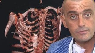 Patlamamış el bombası göğüs kafesine sıkıştı! Doktorlar çelik yelekle ameliyata girdi