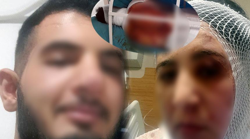 Adana'da üvey annesine kezzapla saldırmıştı! Dehşete düşüren olayın altından bakın ne çıktı