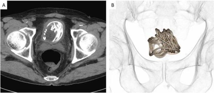 2 metrelik atlama ipini penisinin içine soktu! Doktorlar görünce şoke oldu... “Daha aşırı bir şey görmedim” G1