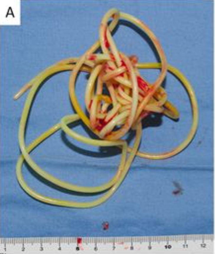 2 metrelik atlama ipini penisinin içine soktu! Doktorlar görünce şoke oldu... “Daha aşırı bir şey görmedim” G2